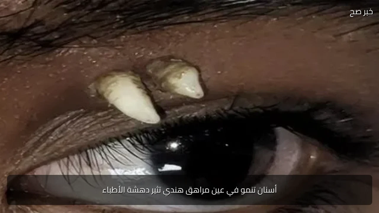 أسنان تنمو في عين مراهق هندي تثير دهشة الأطباء