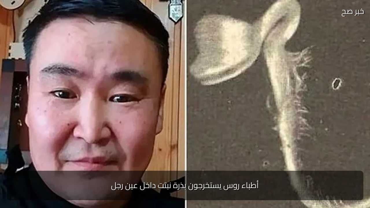 أطباء روس يستخرجون بذرة نبتت داخل عين رجل