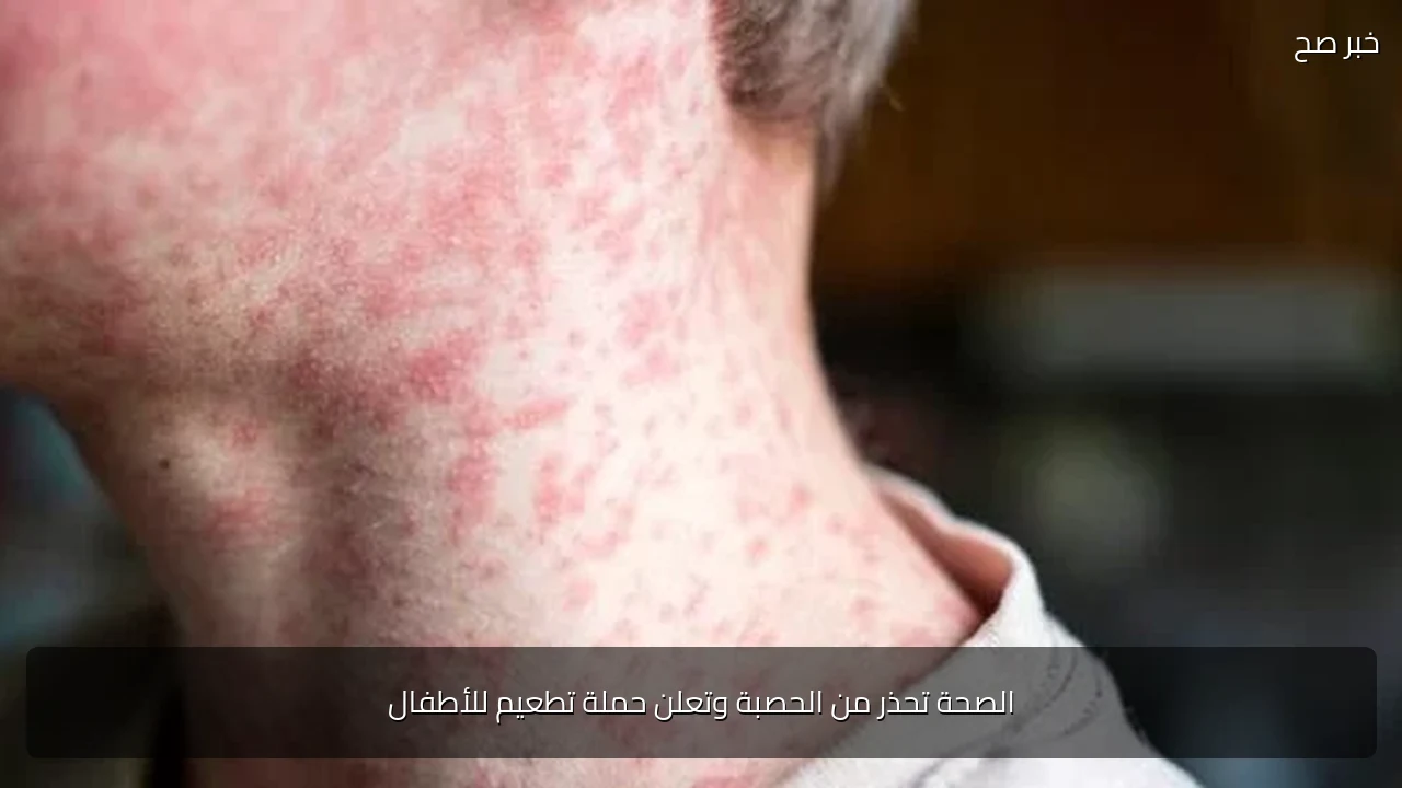 الصحة تحذر من الحصبة وتعلن حملة تطعيم للأطفال