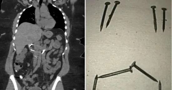 بسبب معاناتها من اضطراب بيكا.. استخراج 8 مسامير كبيرة من أمعاء بريطانية