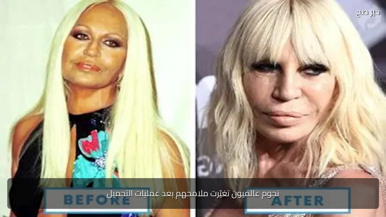 نجوم عالميون تغيّرت ملامحهم بعد عمليات التجميل