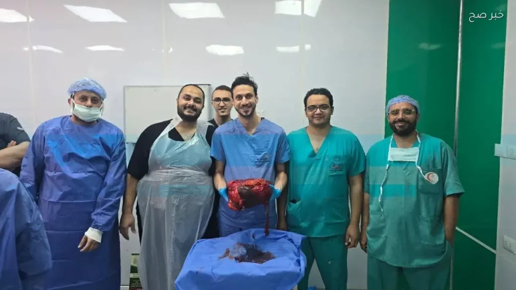 نجاح استئصال ورم نادر يزن 30 كيلو بمستشفى جامعة المنوفية